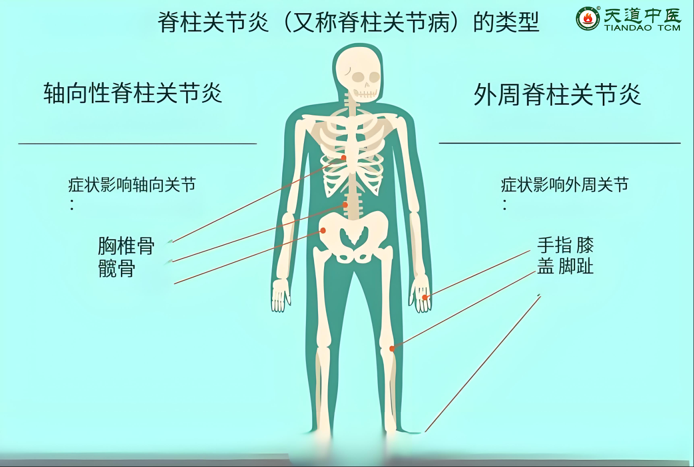 强直性脊柱炎