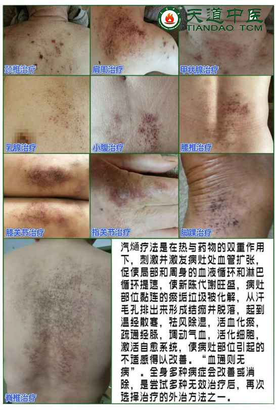 汽熥疗法